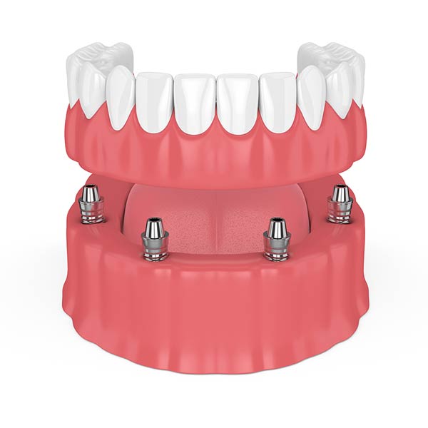 all on four implant denture